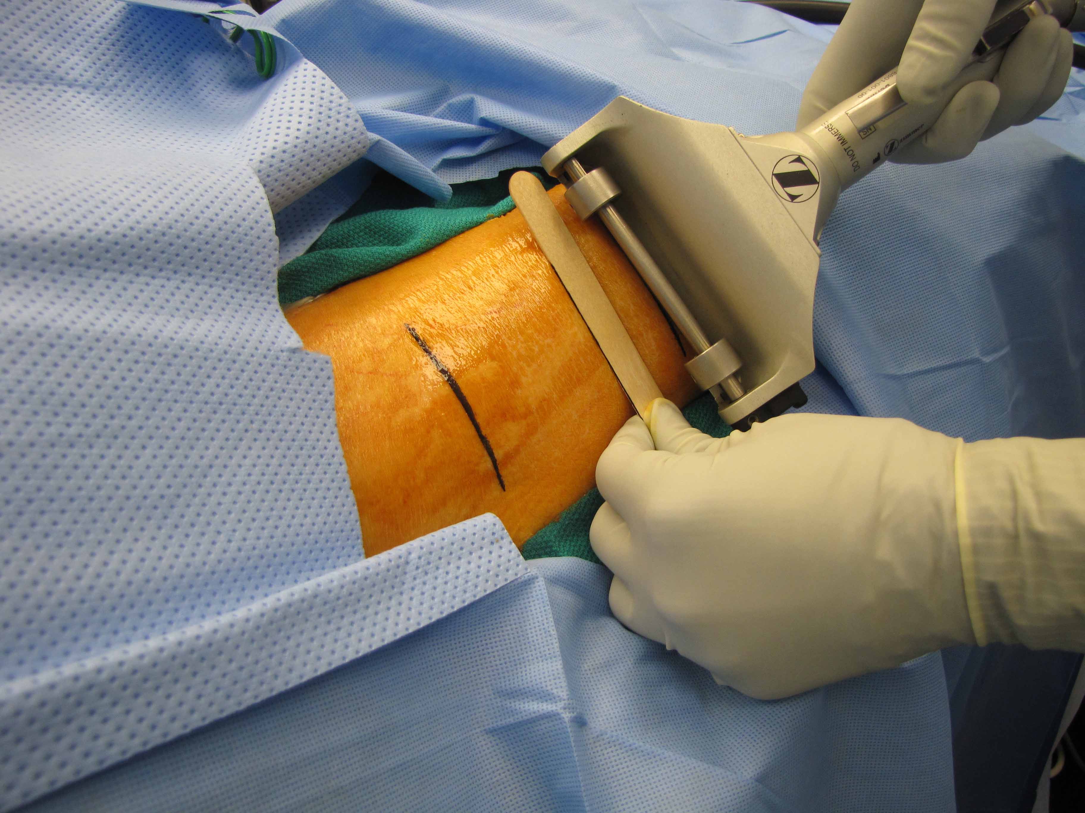 Split Thickness Skin Graft Stsg Zimmer Dermatome Settings With Video